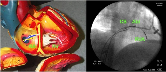Vlevo: Schéma zavedení katetrů do pravé síně a pravé komory na modelu srdce. Volné stěny pravé komory a pravé síně jsou odklopeny. Vidíme tedy do vnitřku srdce. Modrá, bílá a žlutá čára pak představují jednotilivé katetry, které jsou v reálné situaci zobrazené pouze na rentgenu (pravá část obrázku).