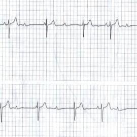 EKG u typického pacienta podstupujícího implantaci trvalého kardiostimulátoru pro AV blokádu.
