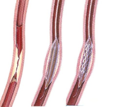 Postup při koronární angioplastice – zavedení vodiče do stenózy, dilatace balónkem, implantace stentu