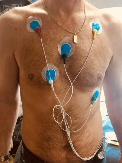 Rozmístění elektrod holterovského EKG záznamníku na hrudi pacienta